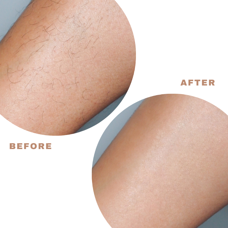 SILQ Hair Eraser before after photos